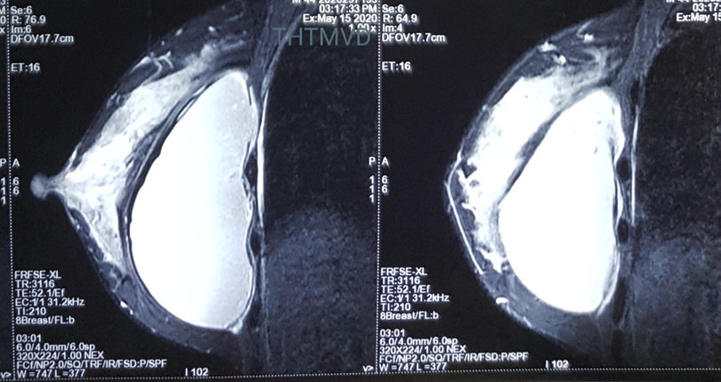 Hình ảnh túi ngực của bệnh nhân (Ảnh: Bệnh viện Hữu nghị Việt Đức)