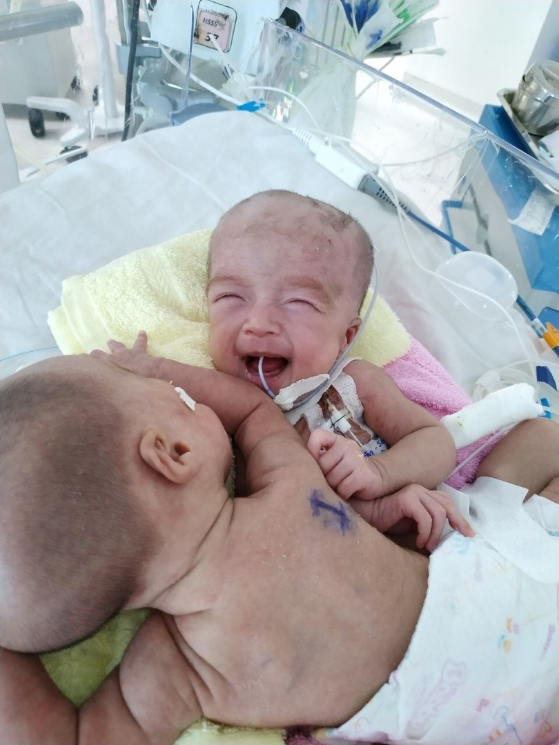 2 bé song sinh khi mới chào đời (Ảnh: Bệnh viện Nhi đồng Thành phố)