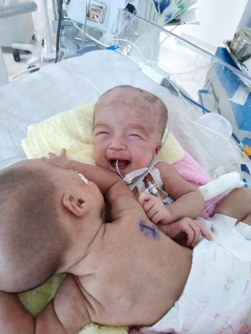 2 bé song sinh khi mới chào đời (Ảnh: Bệnh viện Nhi đồng Thành phố)