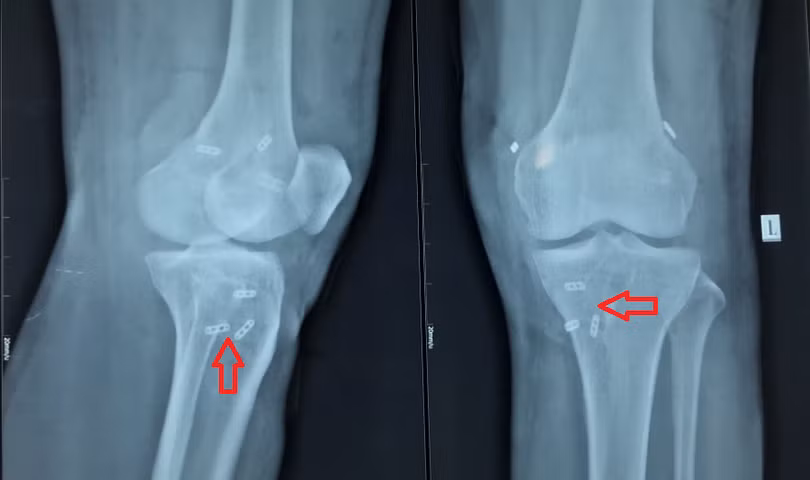 Vị trí các vòng treo gân và vít tự tiêu sau khi tái tạo 3 dây chằng chéo trước, chéo sau, bên ngoài