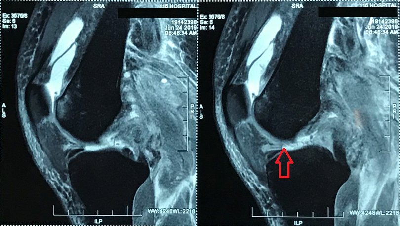 Hình ảnh bị đứt nhiều dây chằng khớp gối trái của bệnh nhân trước khi mổ 