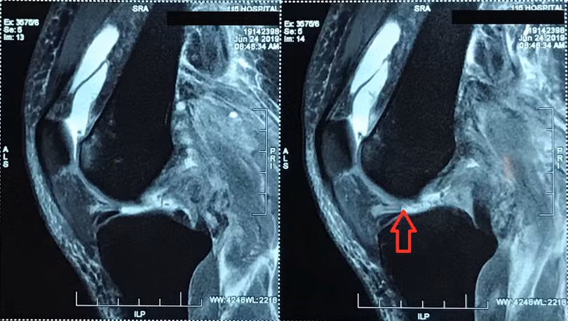 Hình ảnh bị đứt nhiều dây chằng khớp gối trái của bệnh nhân trước khi mổ 