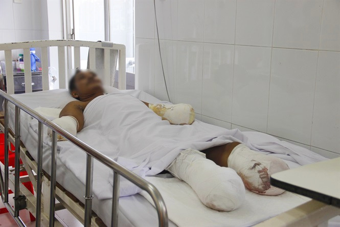 Nạn nhân người Campuchia bị phỏng sâu