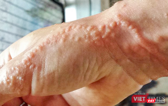 Tình trạng da mẩn đỏ, sau đó phồng rộp mụn nước khi vô tình chạm vào sứa