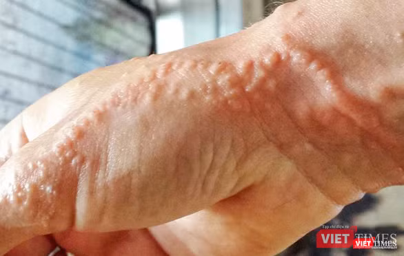 Tình trạng da mẩn đỏ, sau đó phồng rộp mụn nước khi vô tình chạm vào sứa Tình trạng da mẩn đỏ, sau đó phồng rộp mụn nước khi vô tình chạm vào sứa