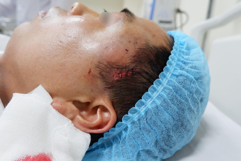 Thái dương của bệnh nhân sưng phồng sau khi phẫu thuật tại cơ sở thẩm mỹ không phép. Ảnh: Bệnh viện E