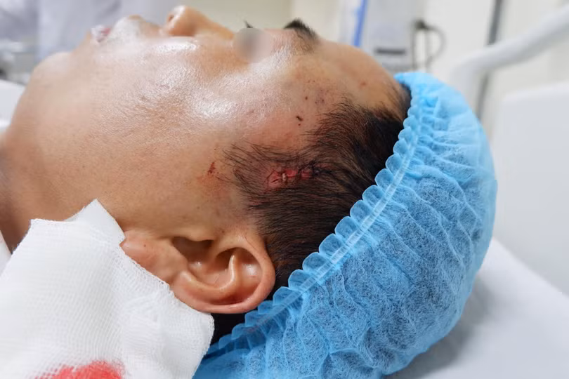 Thái dương của bệnh nhân sưng phồng sau khi phẫu thuật tại cơ sở thẩm mỹ không phép. Ảnh: Bệnh viện E Thái dương của bệnh nhân sưng phồng sau khi phẫu thuật tại cơ sở thẩm mỹ không phép. Ảnh: Bệnh viện E