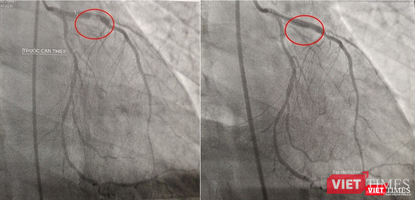 Kết quả chụp DSA mạch vành: bán tắc đoạn gần LAD do huyết khối, can thiệp và đặt stent cho bệnh nhân Kết quả chụp DSA mạch vành: bán tắc đoạn gần LAD do huyết khối, can thiệp và đặt stent cho bệnh nhân