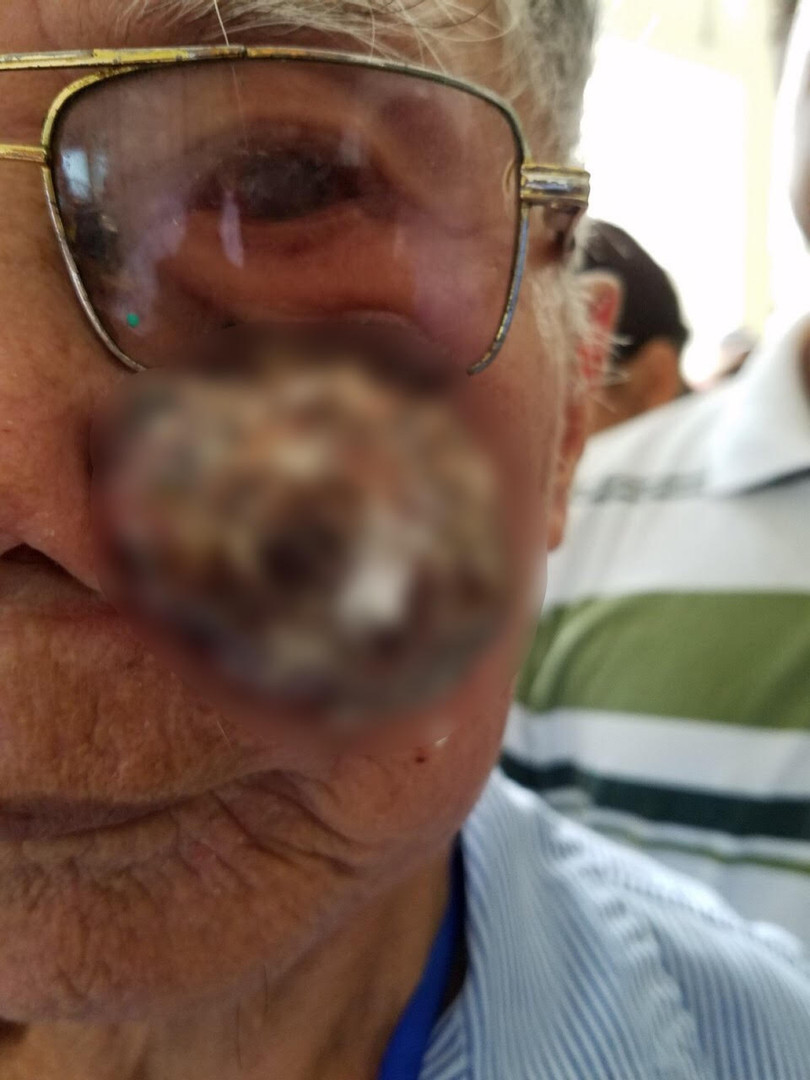 Cụ V. với khối u lở loét trên má trái khi chưa phẫu thuật