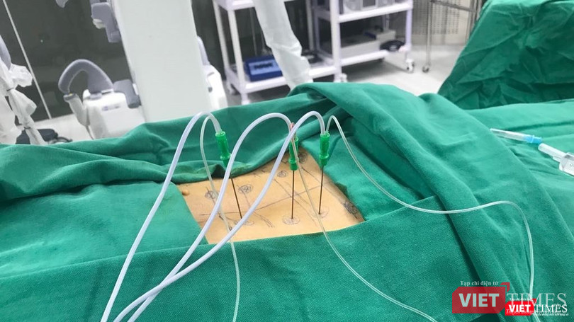 Bệnh nhân thực hiện thủ thuật tiêm cột sống (Ảnh: BVCC)