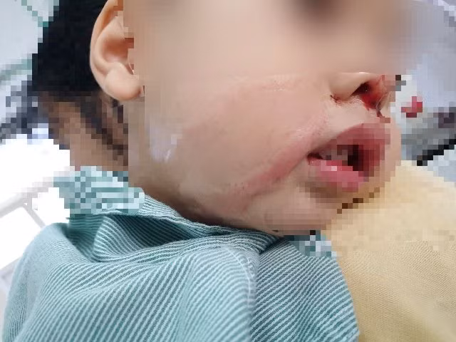 Bé trai phải chịu một vết sẹo dài ở má vì bị bỏng axit.
