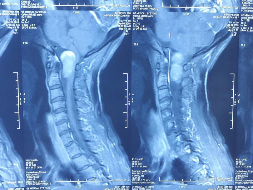Ảnh chụp X-quang vị trí khối u của bà N.