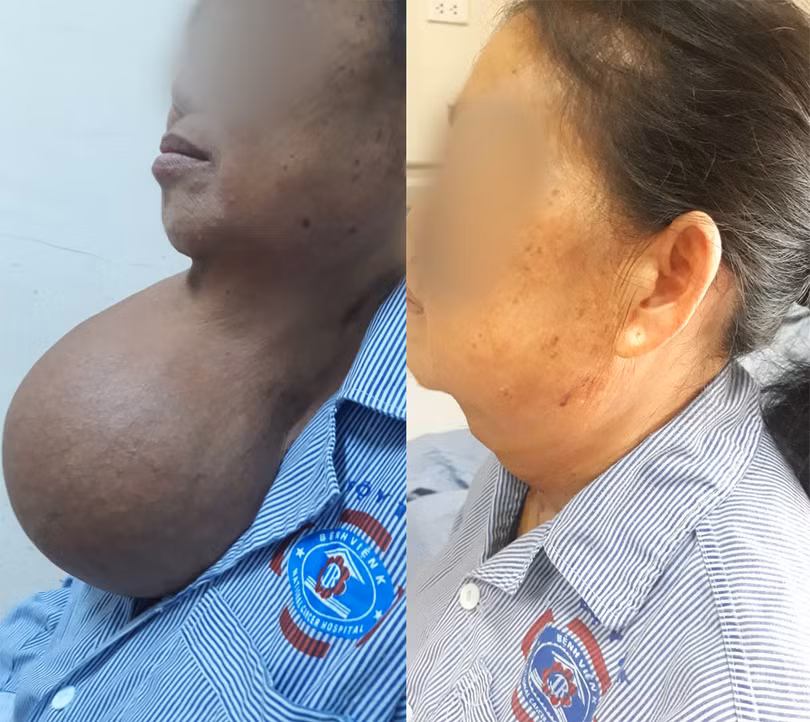 Vùng cổ của bà V. trước và sau khi mổ