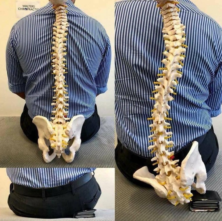 Cột sống bị cong, vẹo vì phải ngồi sai tư thế khi có chiếc ví dày cộm ở túi sau.