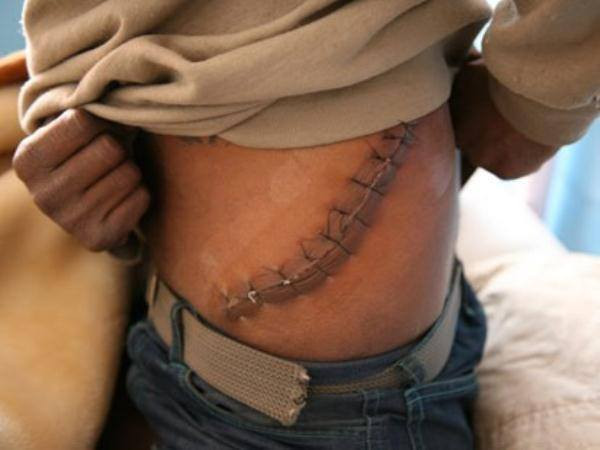 Bán 1 quả thận tỷ lệ thương tật giảm từ 48 đến 69%