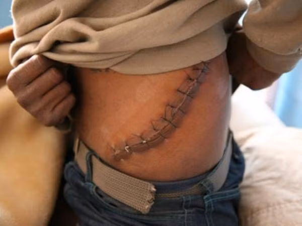 Bán 1 quả thận tỷ lệ thương tật giảm từ 48 đến 69%