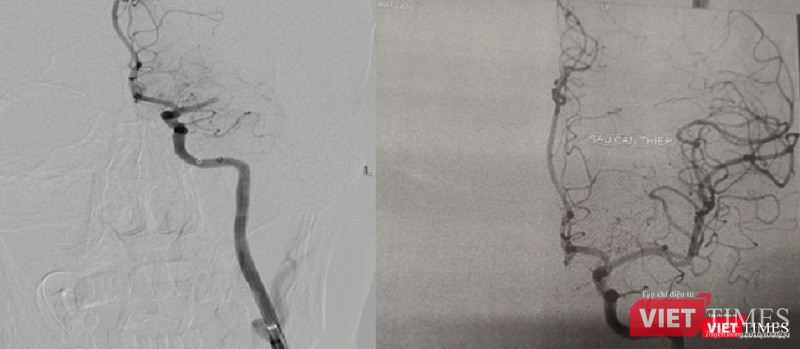 Hình ảnh động mạch não trước và sau khi hút huyết khối Hình ảnh động mạch não trước và sau khi hút huyết khối