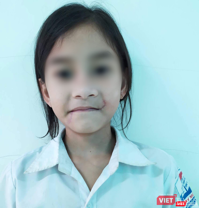 Gương mặt bé T. lành lặn sau khi điều trị Gương mặt bé T. lành lặn sau khi điều trị