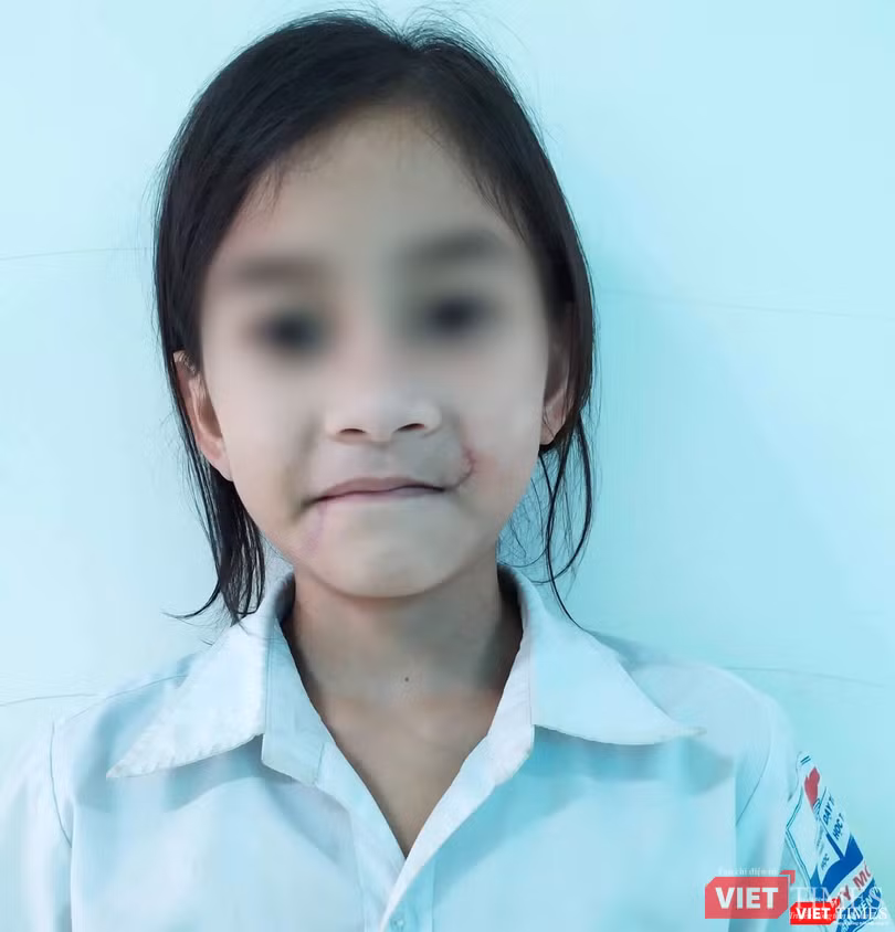 Gương mặt bé T. lành lặn sau khi điều trị