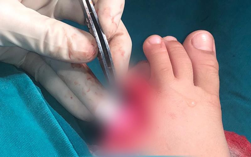 Bàn chân bị thương của bé H.