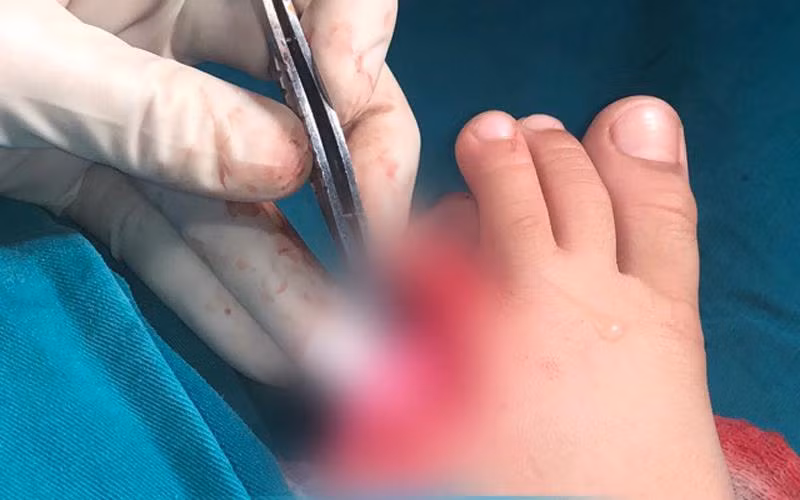 Bàn chân bị thương của bé H. Bàn chân bị thương của bé H.