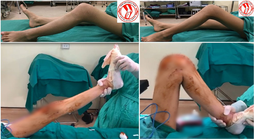 Tình trạng chân của bệnh nhân U. trước và sau khi phẫu thuật.