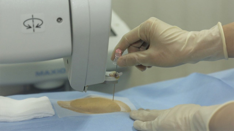 Chỉ với một lần chọc kim duy nhất, các bác sĩ can thiệp chính xác vào vị trí của hạch thân tạng. Chỉ với một lần chọc kim duy nhất, các bác sĩ can thiệp chính xác vào vị trí của hạch thân tạng.