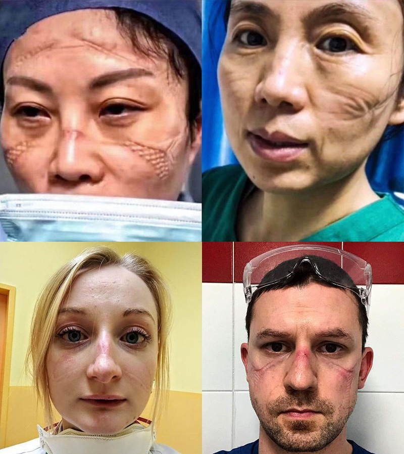 Khuôn mặt sưng đỏ, in vết hằn khẩu trang của đội ngũ y bác sỹ tuyến đầu các nước trong trận chiến chống dịch Covid-19. Do làm việc với cường độ cao và không có thời gian nghỉ ngơi khiến sức khỏe và sự đề kháng yếu đi, các bác sỹ, y tá là những người dễ gặp nguy hiểm nhất nếu bị lây nhiễm virus.