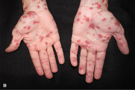 Bàn tay của một người mắc bệnh giang mai