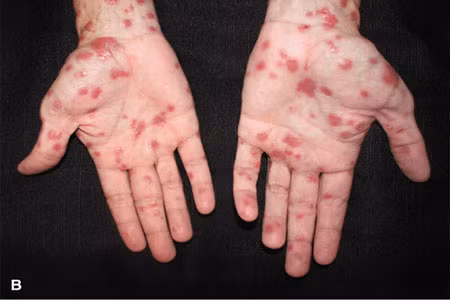 Bàn tay của một người mắc bệnh giang mai