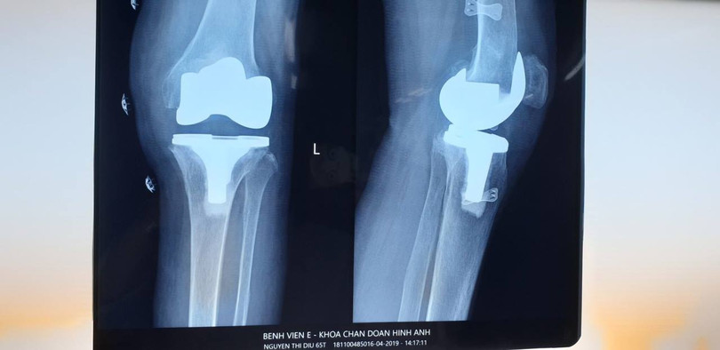 Ảnh chụp Xquang khớp gối của bệnh nhân