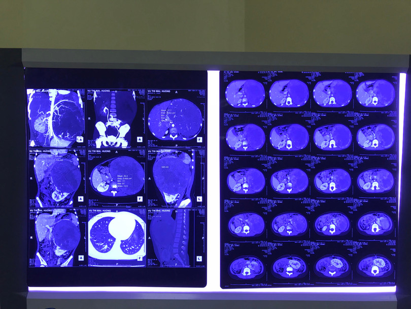 Phim chụp X-quang của em H. Phim chụp X-quang của em H.
