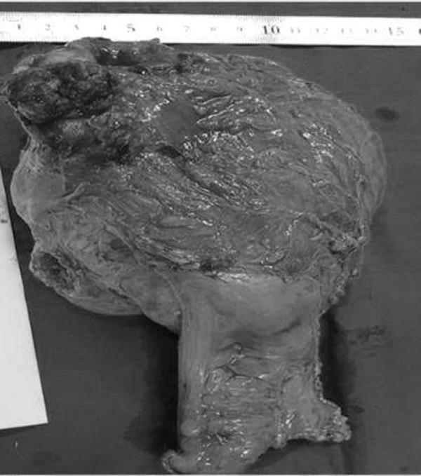 Khối u lớn cắt ra từ trực tràng của bệnh nhân Khối u lớn cắt ra từ trực tràng của bệnh nhân