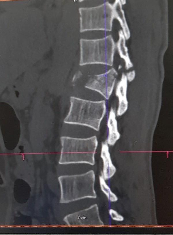 Ảnh minh họa đoạn đốt sống L1 trên cơ thể Ảnh minh họa đoạn đốt sống L1 trên cơ thể