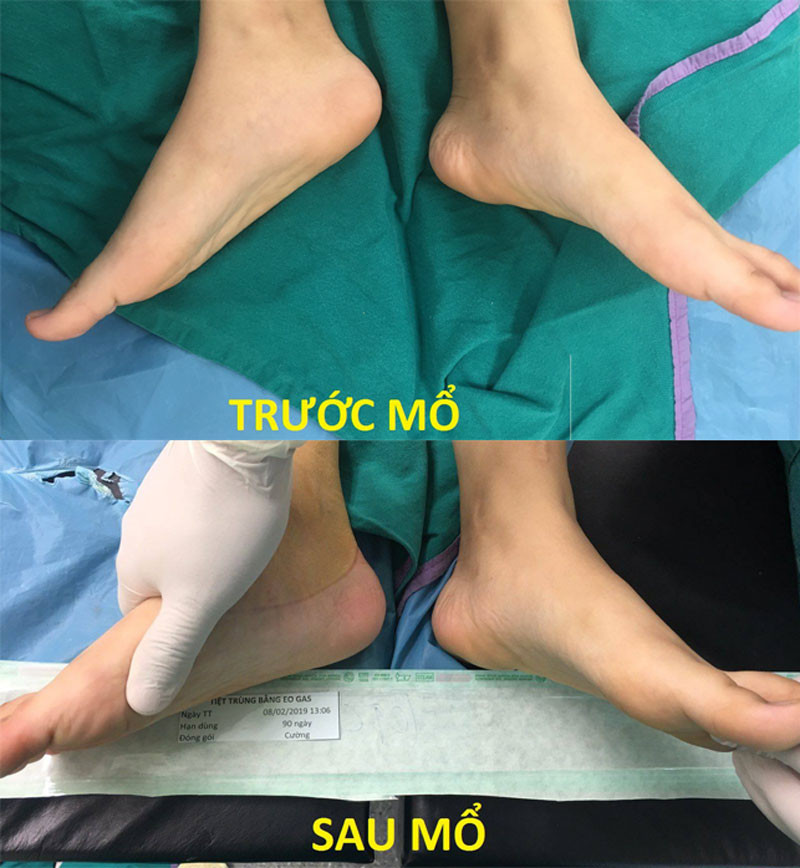 Mãi tới lần thứ 3 phẫu thuật, bệnh của C. mới được chữa khỏi, đồng thời, khắc phục dáng đi khác thường của em.