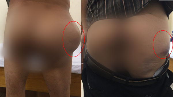 Khối u kích thước lớn khiến cho các bệnh nhân bị biến dạng cơ thể Khối u kích thước lớn khiến cho các bệnh nhân bị biến dạng cơ thể