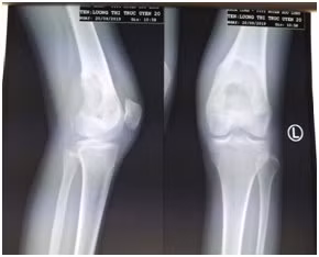 Phim chụp X-quang phần xương đùi của bệnh nhân