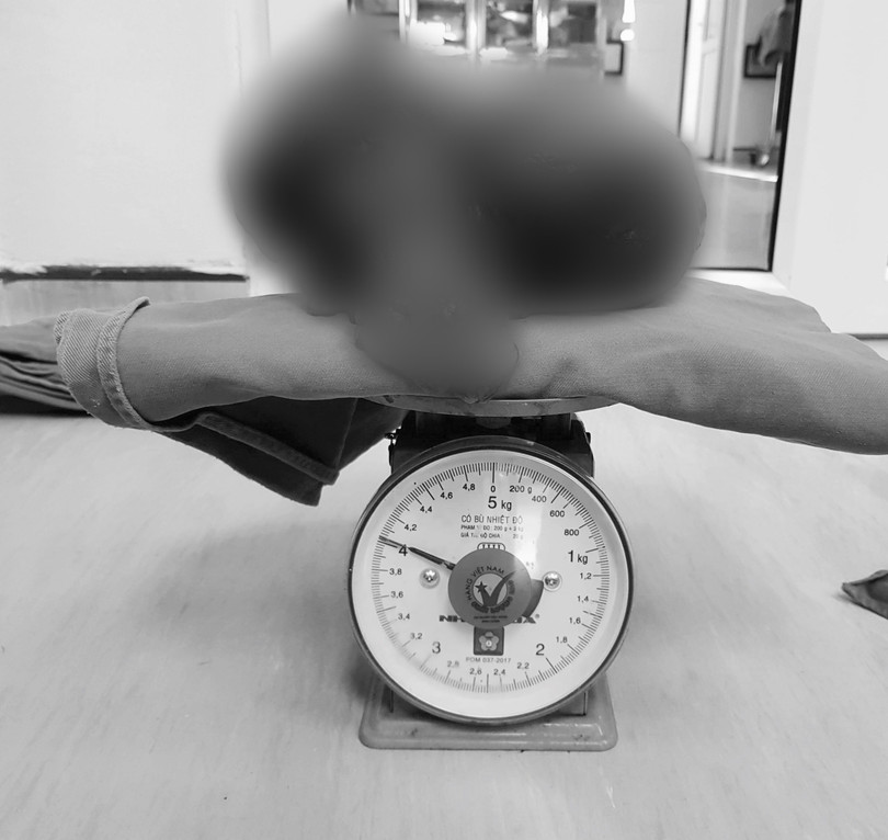 Khối u nặng gần 4kg lấy ra từ bụng bệnh nhân