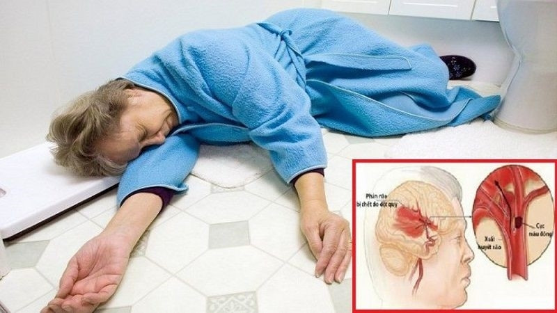 Bệnh nhân ngất xỉu khi bị đột quỵ não. Bệnh nhân ngất xỉu khi bị đột quỵ não.
