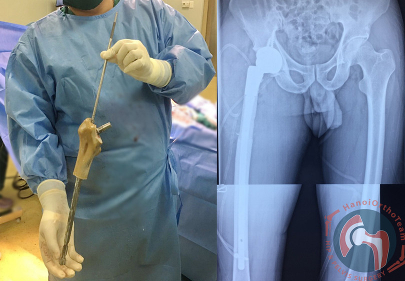 Hình ảnh thực tế của đoạn xương nhân tạo được cấy ghép