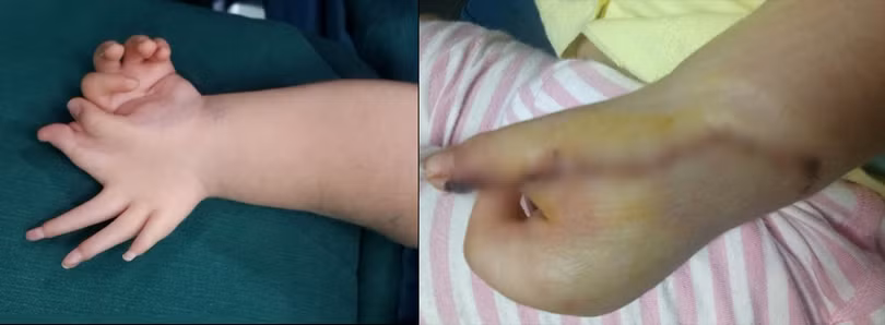 Bàn tay của trẻ trước và sau phẫu thuật