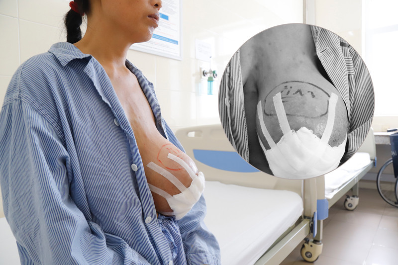 Khối u khiến ngực trái của chị C. sưng to Khối u khiến ngực trái của chị C. sưng to