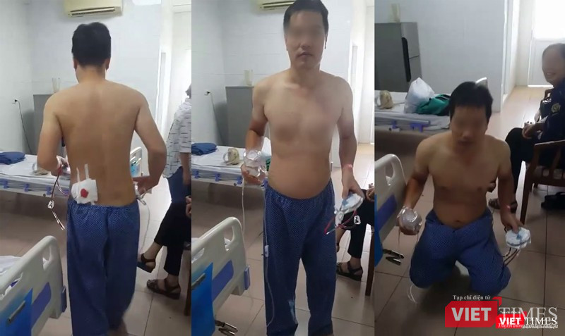 Một bệnh nhân tại Bệnh viện Thanh Nhàn phục hồi sau khi được áp dụng phương pháp phẫu thuật nội soi chữa thoát vị đĩa đệm cột sống qua lỗ liên hợp. Một bệnh nhân tại Bệnh viện Thanh Nhàn phục hồi sau khi được áp dụng phương pháp phẫu thuật nội soi chữa thoát vị đĩa đệm cột sống qua lỗ liên hợp.