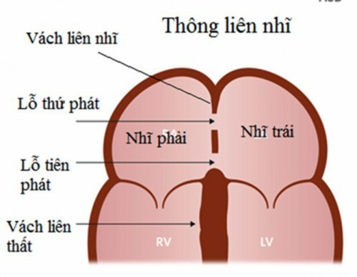 Hình minh họa bệnh thông liên nhĩ ở trẻ Hình minh họa bệnh thông liên nhĩ ở trẻ
