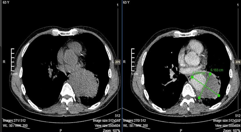 Ảnh chụp CT cho thấy động mạch của anh Q. bị phình