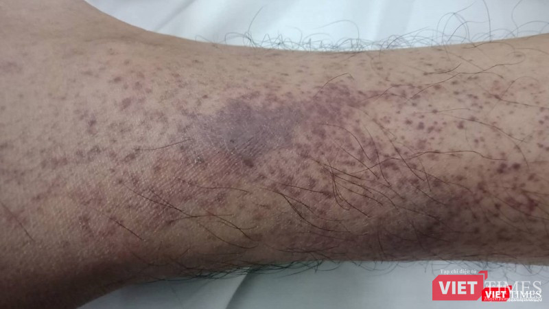 Tình trạng xuất huyết nặng dươi da của một bệnh nhân mắc sốt xuất huyết trên nền bệnh tan máu bẩm sinh -Thalassemia - tại Bệnh viện Bạch Mai.