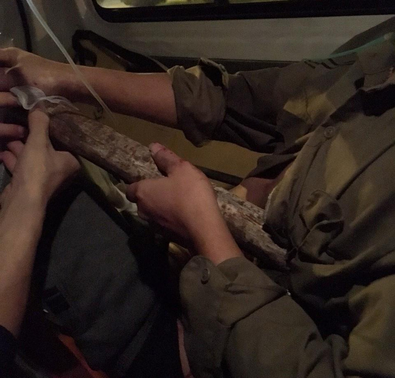 Thanh sắt đâm xuyên qua ngực trái của bệnh nhân