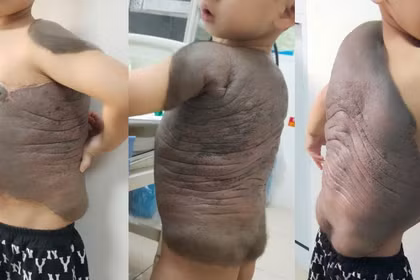 Cậu bé mang trên mình khối u rất lớn