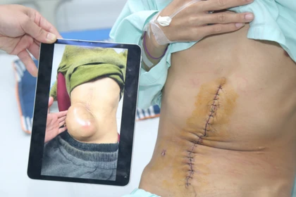 So sánh khối u lúc bệnh nhân đến BV và vết mổ sau khi cắt khối u