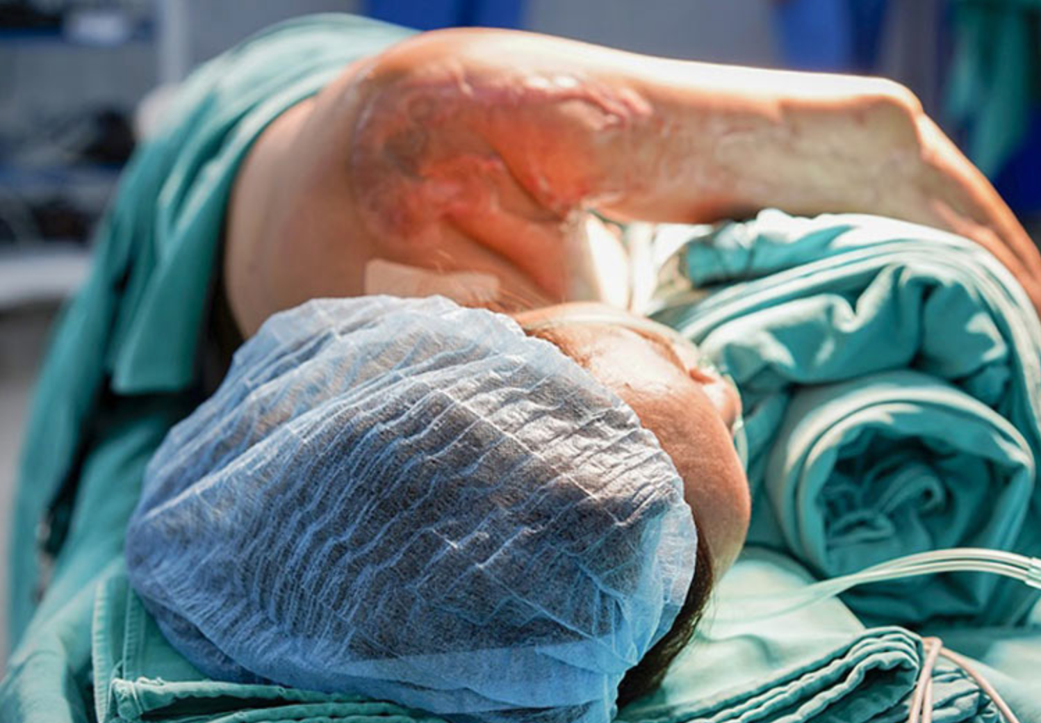 Chị In trên bàn mổ chuẩn bị được thay khớp (Ảnh - BVCC)